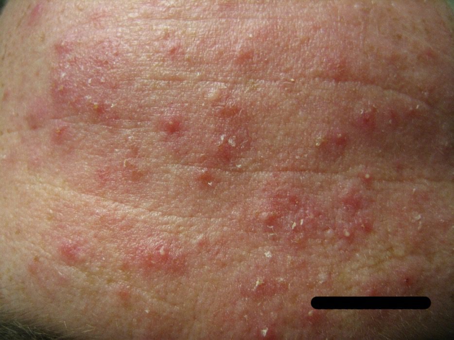 Numerous red bumps and pus bumps